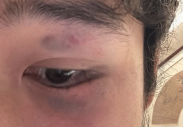 阮奇龍報平安 頭部遭任意球重?fù)艉蟪霈F(xiàn)頭暈嘔吐癥狀